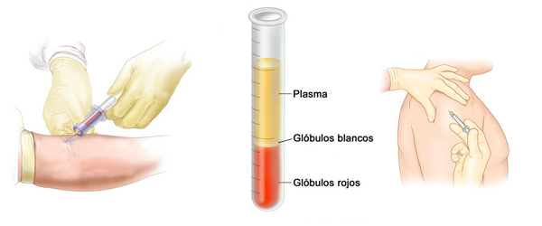 BIOESTIMULACIÓN
CON PLASMA RICO EN PLAQUETAS